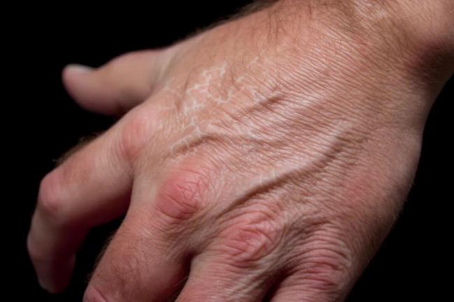 這樣洗澡當心越洗越癢！防手足皸裂必看