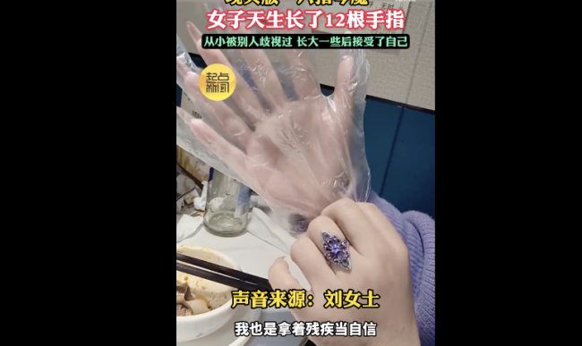 女子長12根手指自稱靈活好用 悅納不同活出精彩
