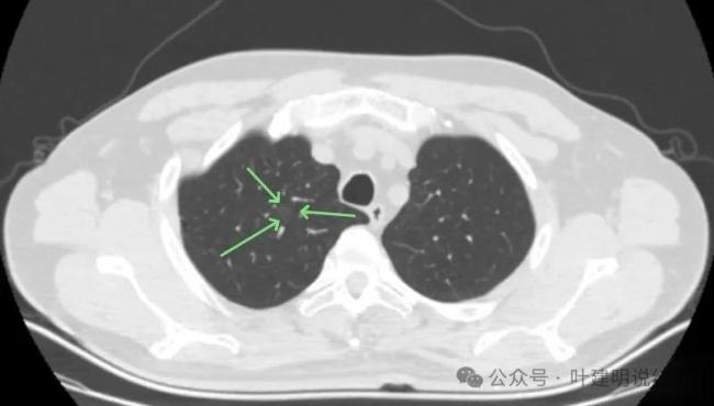 32歲兒子陪護69歲母親雙雙確診肺癌 早篩挽救生命