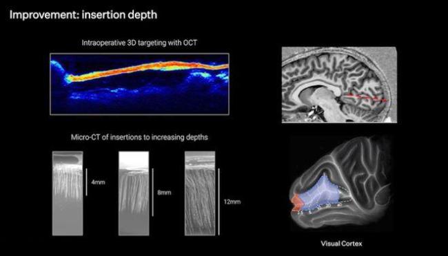馬斯克機器人“開顱插針”僅1.5秒 未來腦機接口手術(shù)效率飛躍