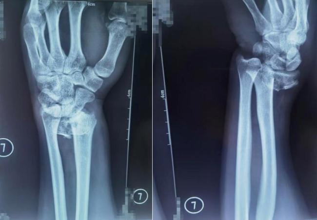 雪后北京積水潭醫(yī)院骨科已接診170人 滑倒摔傷患者激增