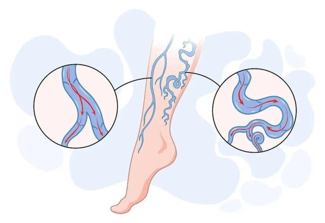 血管堵不堵 看臉和腿就知道？6個(gè)信號(hào)別忽視