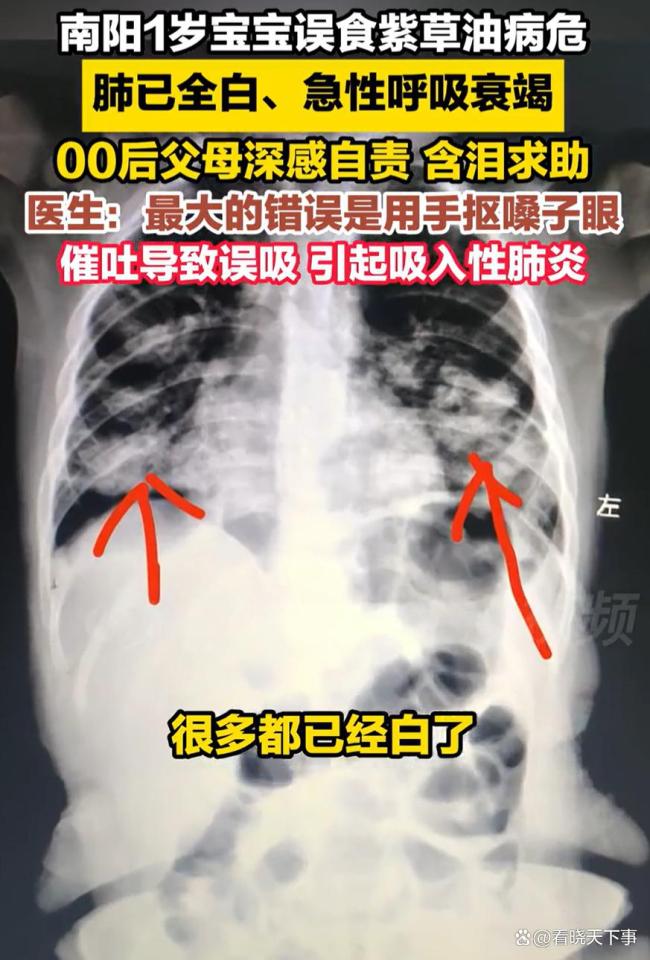 1岁宝宝误食紫草油病危 肺已全白 催吐不当致病情加重