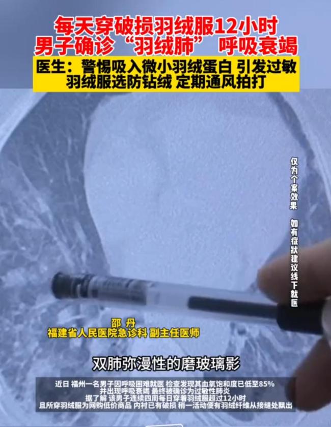 羽绒服“漏绒”致呼吸衰竭！医生：警惕“羽绒肺” 长期穿着破损羽绒服风险大