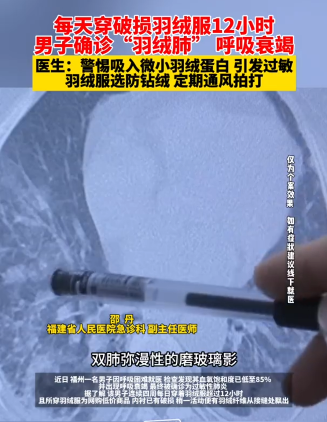 羽绒服“漏绒”致呼吸衰竭！医生：警惕“羽绒肺”