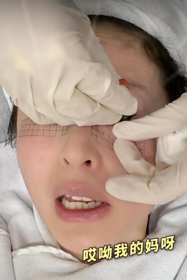 颖儿做眼部热玛吉疼哭了 明星的美丽代价