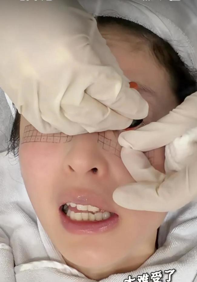 颖儿做眼部热玛吉疼哭了 明星的美丽代价