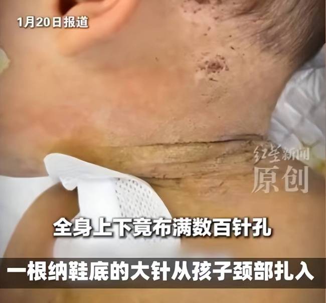 男婴颈椎藏针全身被扎数百针孔
