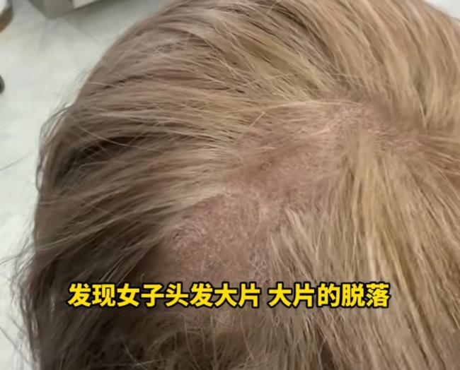 女子漂染头发“翻车” 头皮溃烂长满脓包 头发大片脱落 爱美也要注意健康