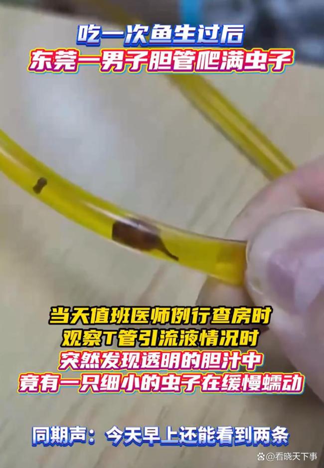 男子结石手术后胆管查出多只寄生虫