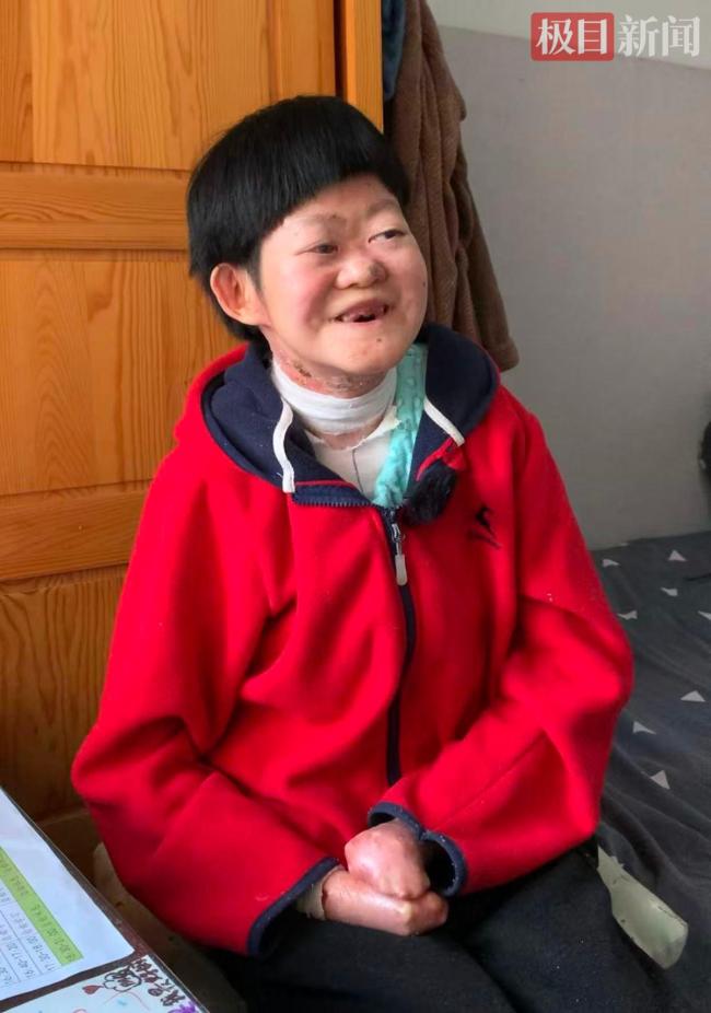 被断言活不过2岁的蝴蝶宝贝将满25岁 生命奇迹续写希望