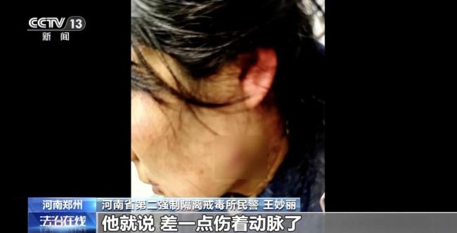 夺刀女警脸上伤疤无法恢复如初 英勇事迹获表彰