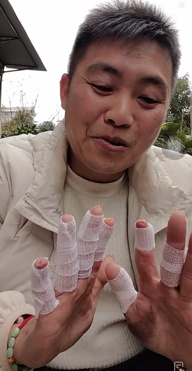 男子从着火电车救下3人手几乎烧废 英勇行为获赞