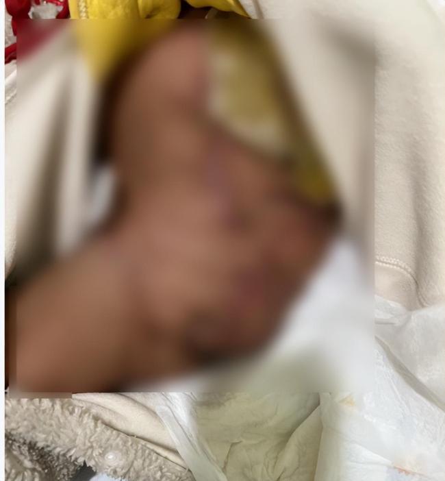1歲寶寶被撞后截肢截骨盆 血淚警示兒童安全