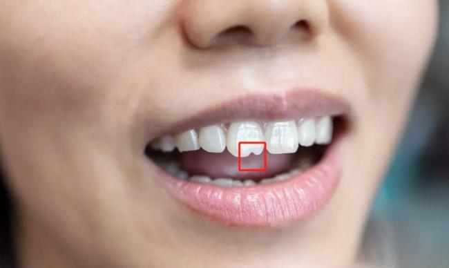 门牙上的“豁”到底是怎么来的