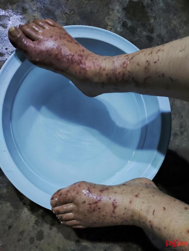 68岁老人离家走失8天吃树叶生还 村民合力搜救成功