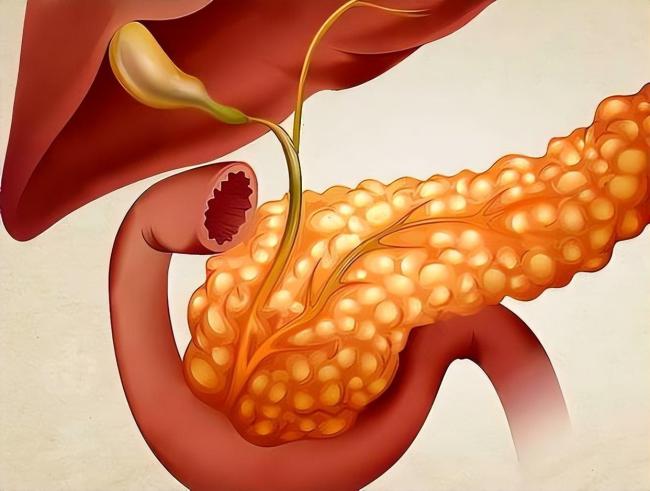 女子过年大鱼大肉致重症胰腺炎 节日饮食需谨慎