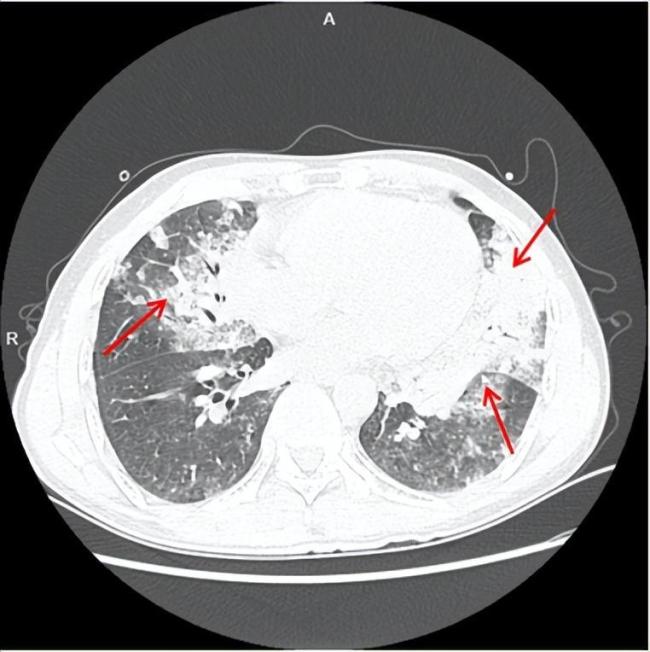 工人被呛柴油6小时现大面积白肺 一口柴油引发急性肺炎