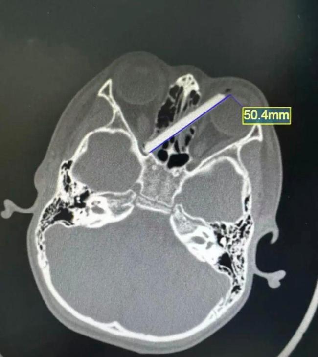 男孩摔倒筷子插进眼睛