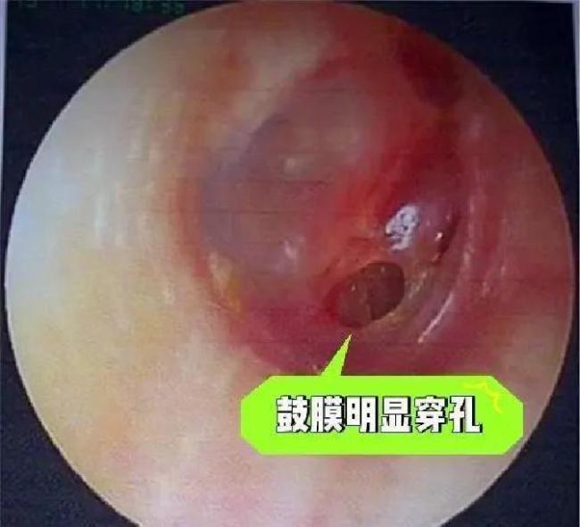 女子看热闹鼓膜被震出大窟窿 礼炮声中的“看不见的危险”