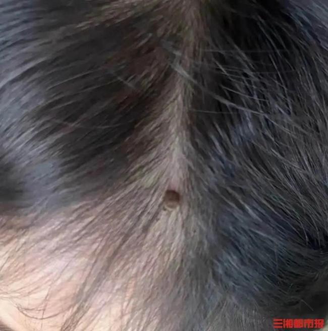 1岁幼儿睡前发现蜱虫钻进头皮在吸血 春季警惕毒虫出没