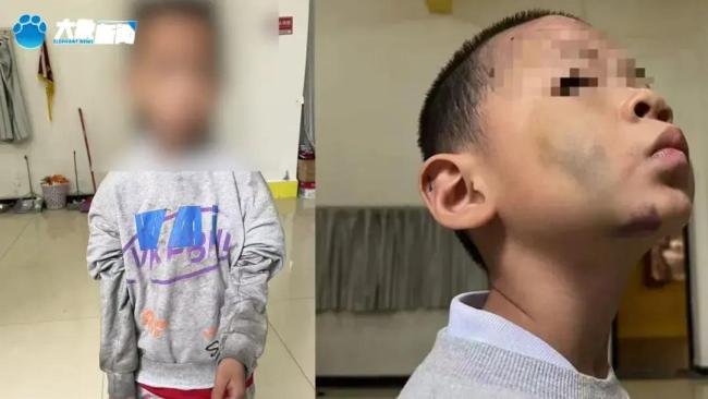 湖南姐弟俩遭继母生父虐待长达5年 满身伤痕触目惊心