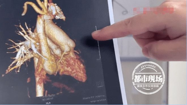 嘴唇发紫 心脏不好 先心病患儿手术成功