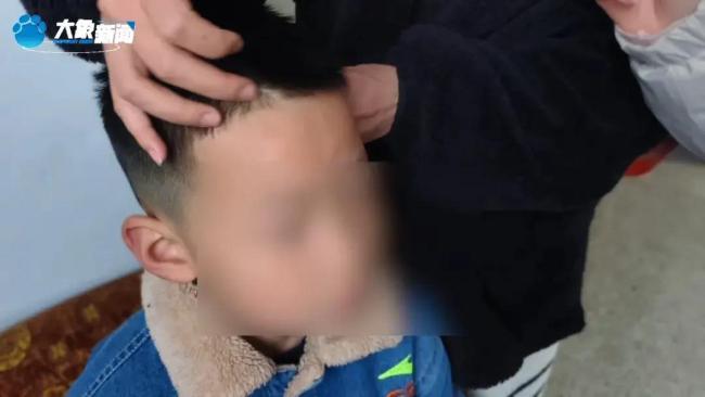 湖南一对姐弟遭生父继母虐待 满身伤痕触目惊心