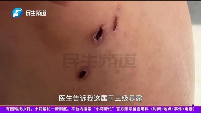 女子被流浪狗咬伤后狗死了