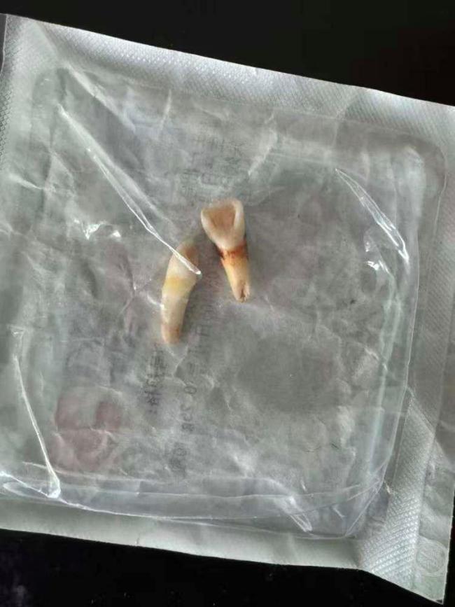 男孩遭母亲同居男友殴打致轻伤二级