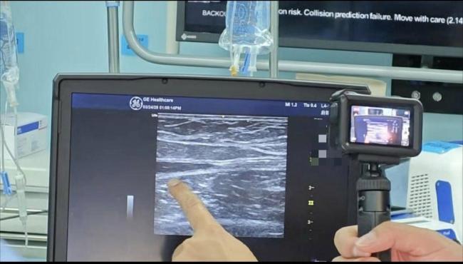 浙江大伯蚯蚓腿被胶水粘好了 不开刀不打麻药治愈