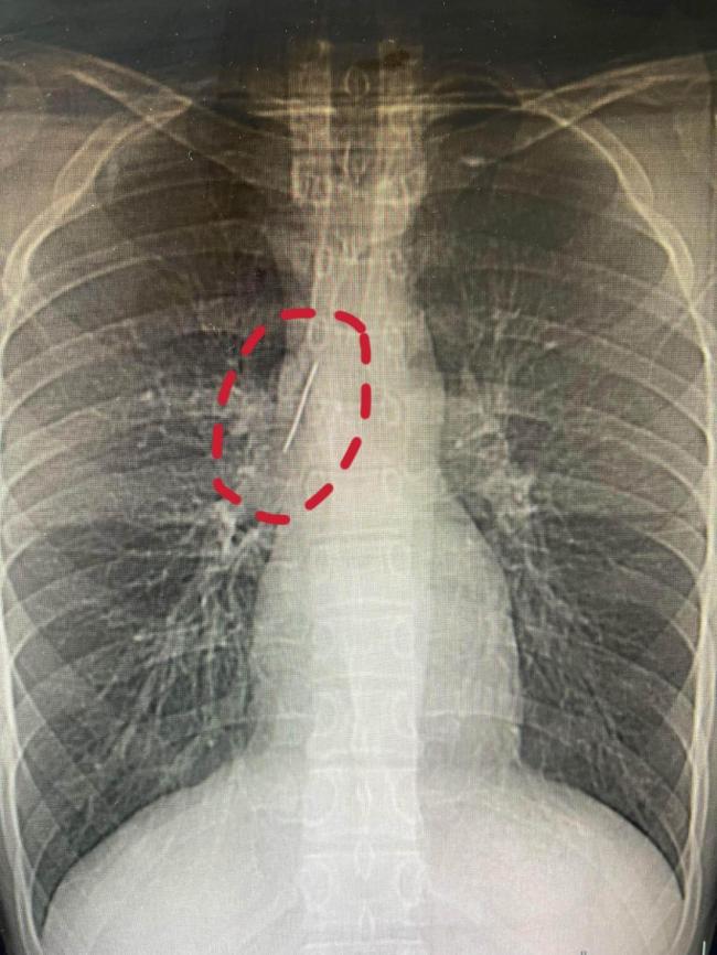 男子体检发现胸腔藏了一根缝衣针