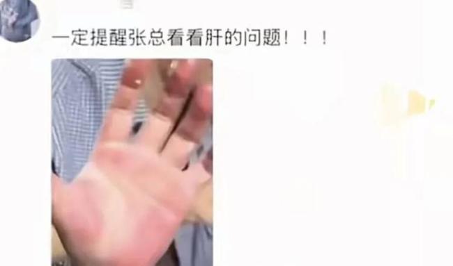手掌太红！张雪被提醒及时就医 网友热议肝掌疑云