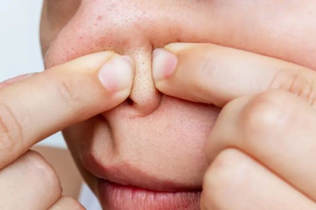 为什么下巴会长小颗粒 青春期皮脂腺活跃所致