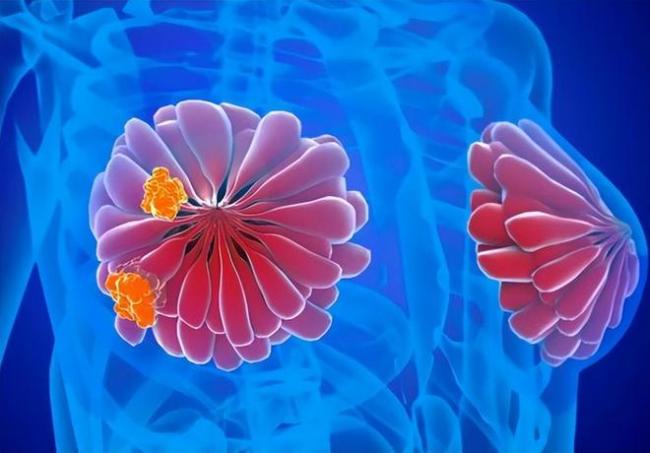 乳腺结节有3个特征更易癌变 科学应酬别慌