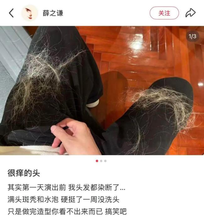 薛之谦自曝因染发导致斑秃