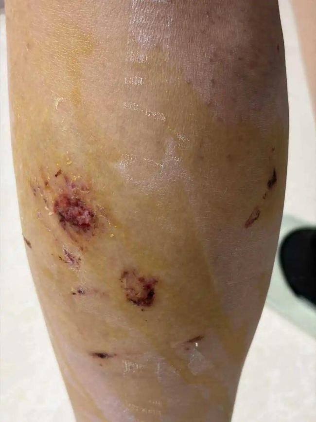 校方回应女生被群狗围堵咬伤20多处