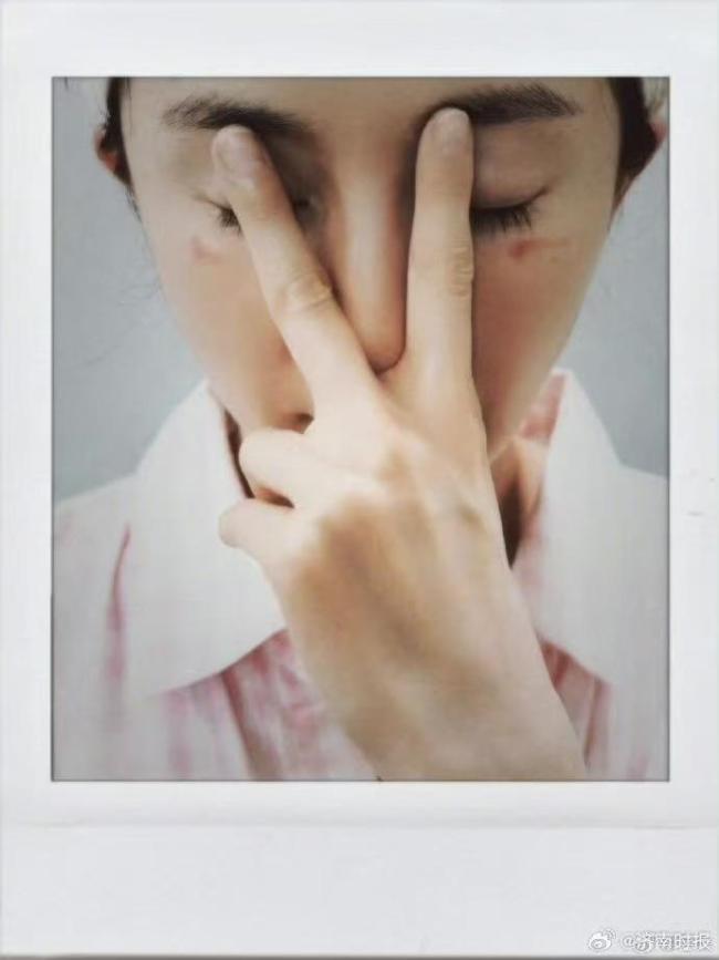 杨幂自曝被蒸汽眼罩“咬伤”！双眼下方有两道红色烫伤痕迹 使用不当引发关注