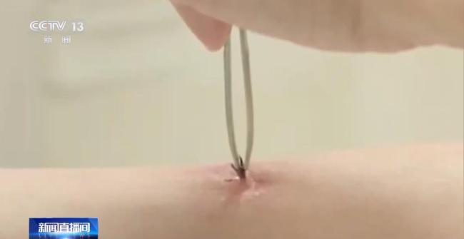 不慎被蜱虫叮咬千万别“硬拔”