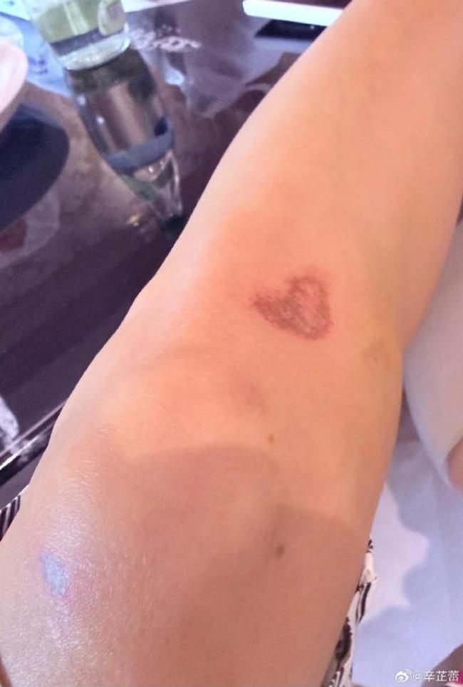 辛芷蕾骑车又摔了四肢全废 骑行安全引关注