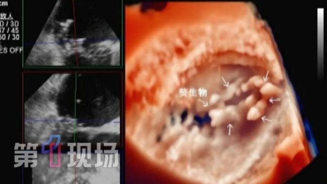 51岁男子心脏长了个“马蜂窝”