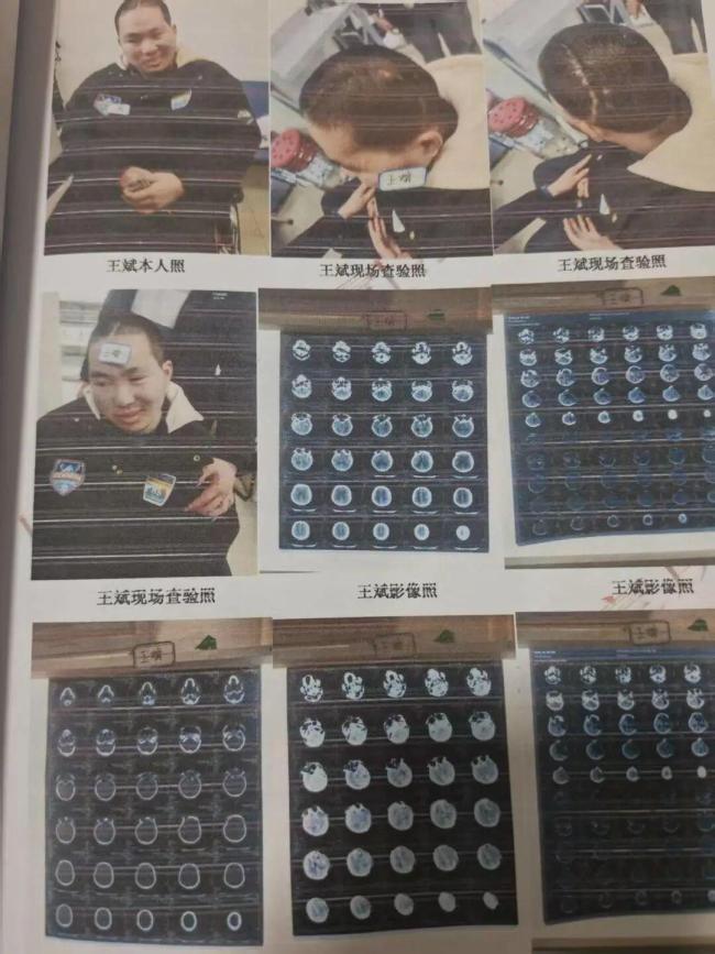 肇事方回应23岁研究生被撞颅脑损伤 两个家庭的悲剧