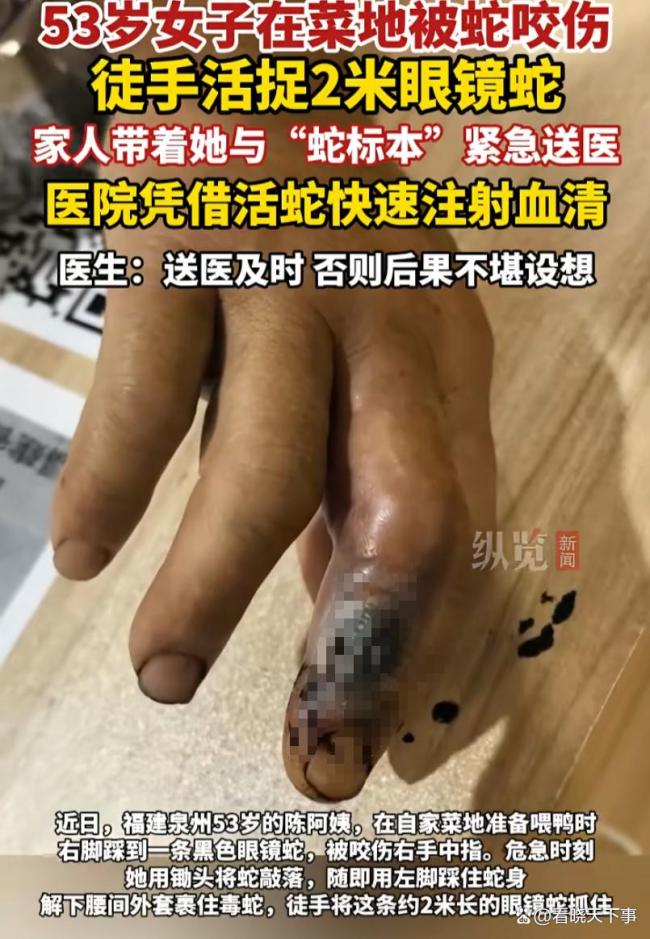 53岁阿姨被眼镜蛇咬伤后 徒手擒蛇