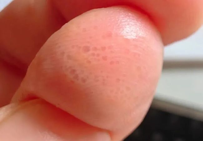 夏天手上爱长的小水疱 到底是什么 汗疱疹的特点与应对