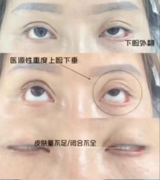 女子割双眼皮后无法闭眼，整形机构老板获刑后反起诉，女子被判退还20万元 整形失败引发法律纠纷