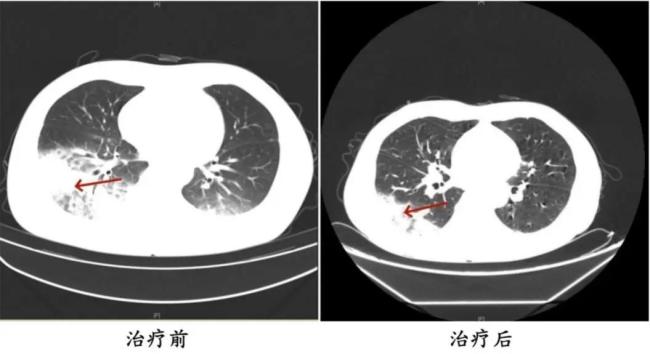 開了一晚上空調(diào) 女子肺白了大半 警惕空調(diào)里的“呼吸刺客”
