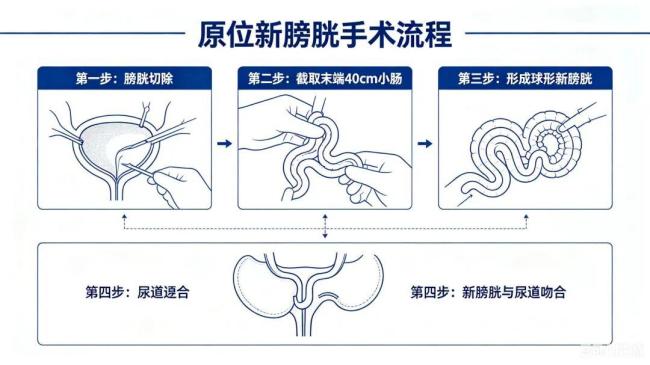 医生为癌症男子做了“新膀胱” 告别终身挂袋重获尊严