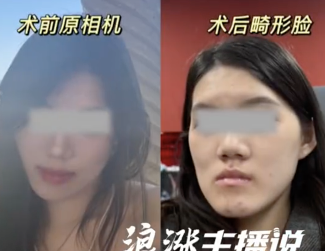 女孩做正頜手術(shù)反成鞋拔子臉 衛(wèi)健委介入調(diào)查