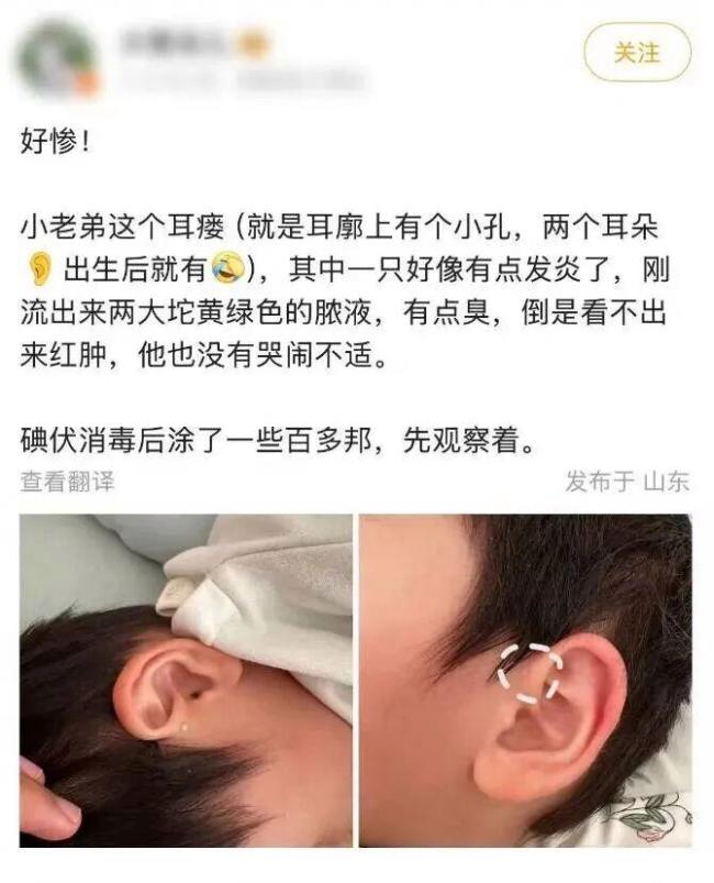耳朵上的这个小洞千万别挤