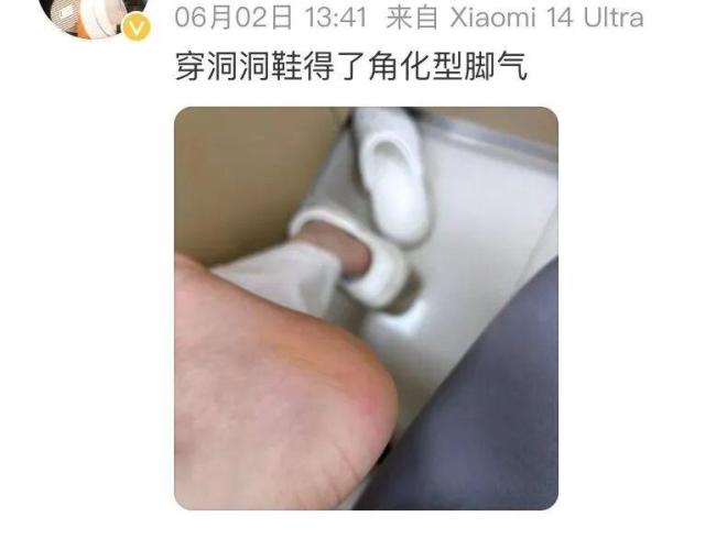 广东人爱穿洞洞鞋小心脚气